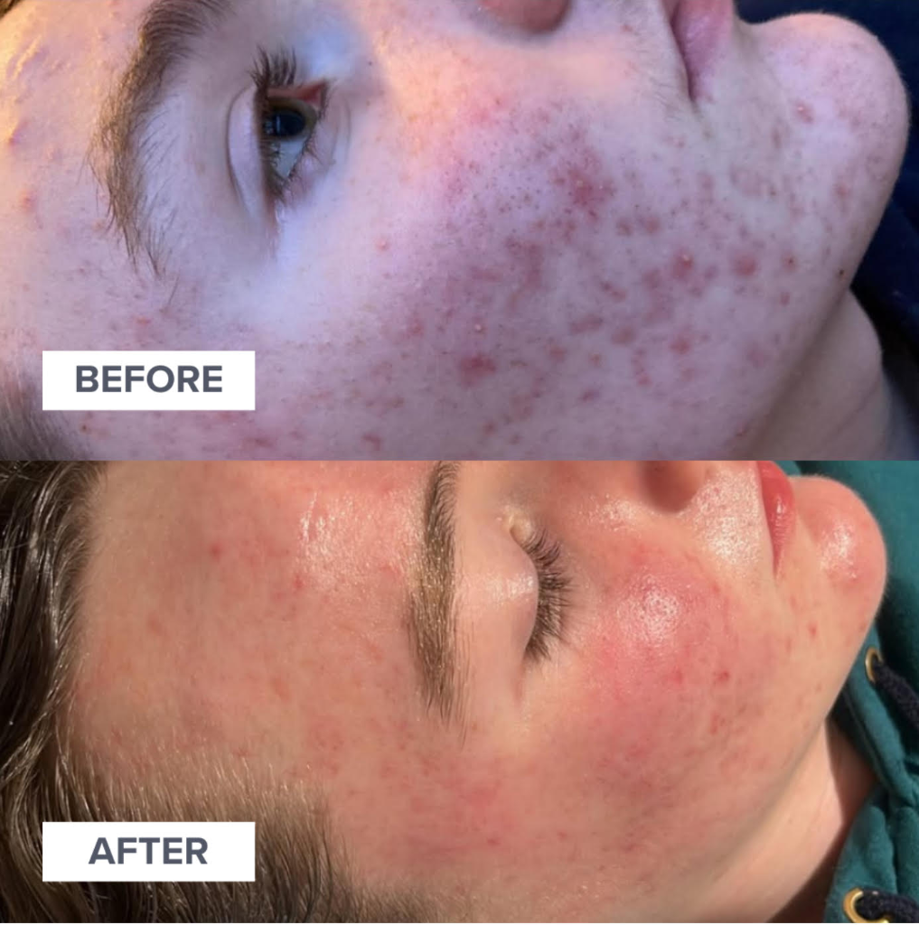 Chemical Peel Before and After Results