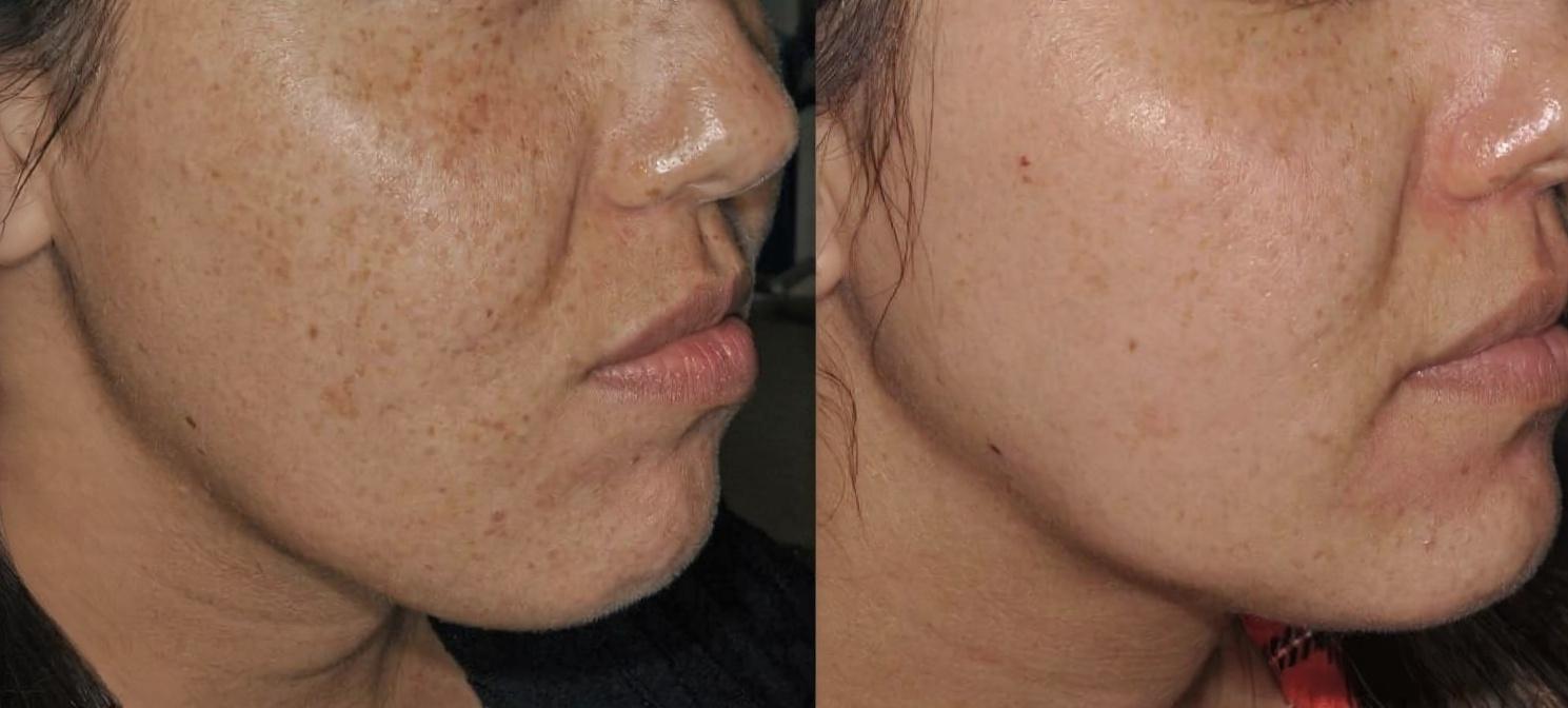 Lumecca IPL Before and After - Cheek Pigmentation