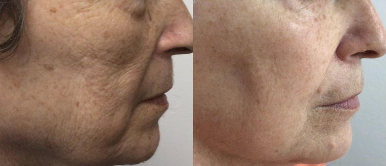 Lumecca IPL Before and After - Facial Sun Damage