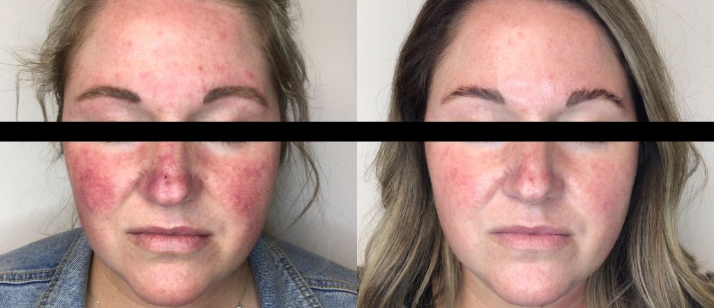 Lumecca IPL Before and After - Facial Redness and Rosacea
