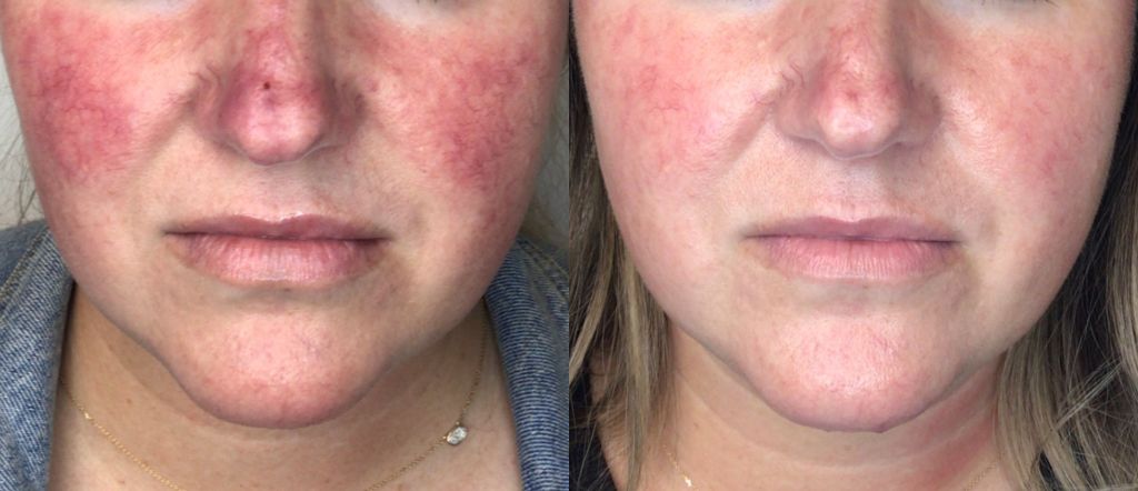 Lumecca IPL Before and After - Full Face Rosacea