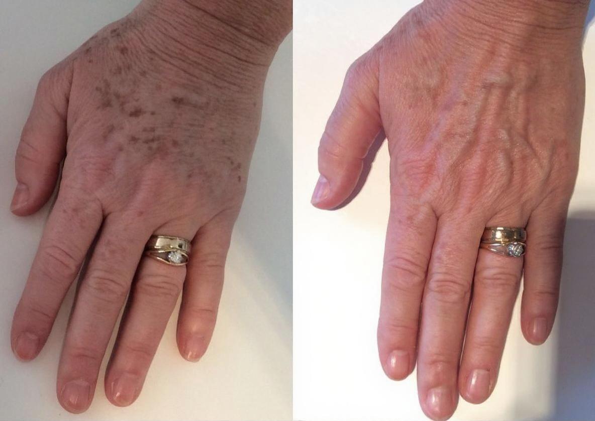 Lumecca IPL Before and After - Hand Age Spots