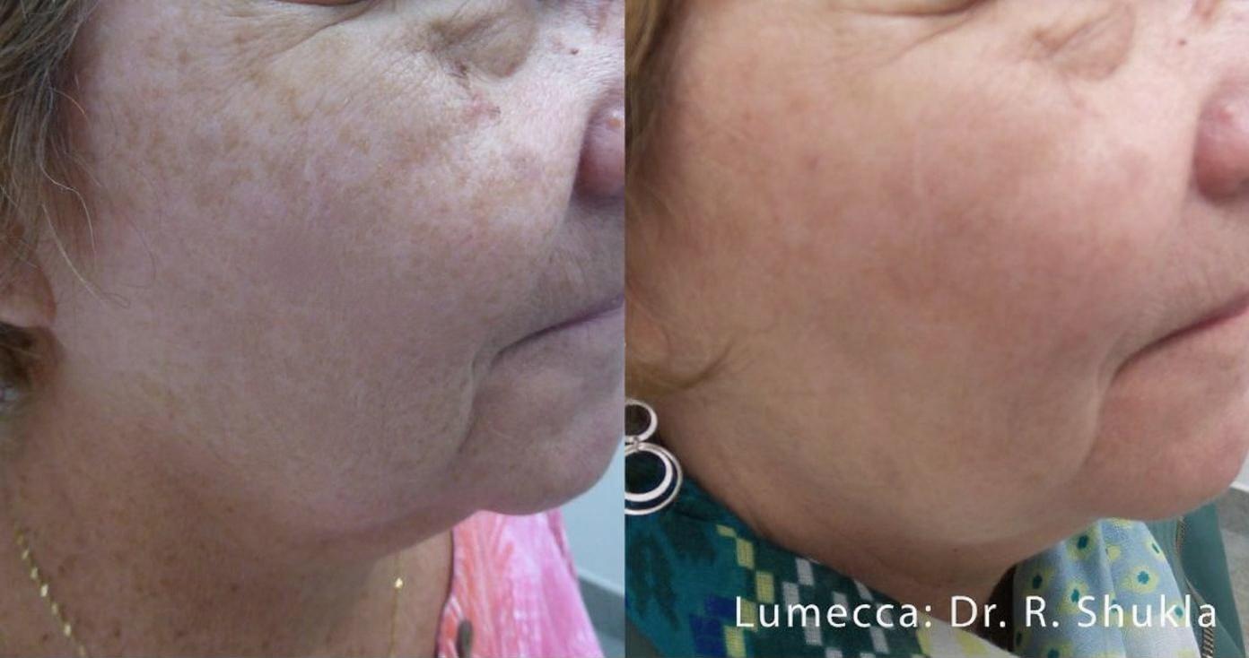 Lumecca IPL Before and After - Neck Sun Damage