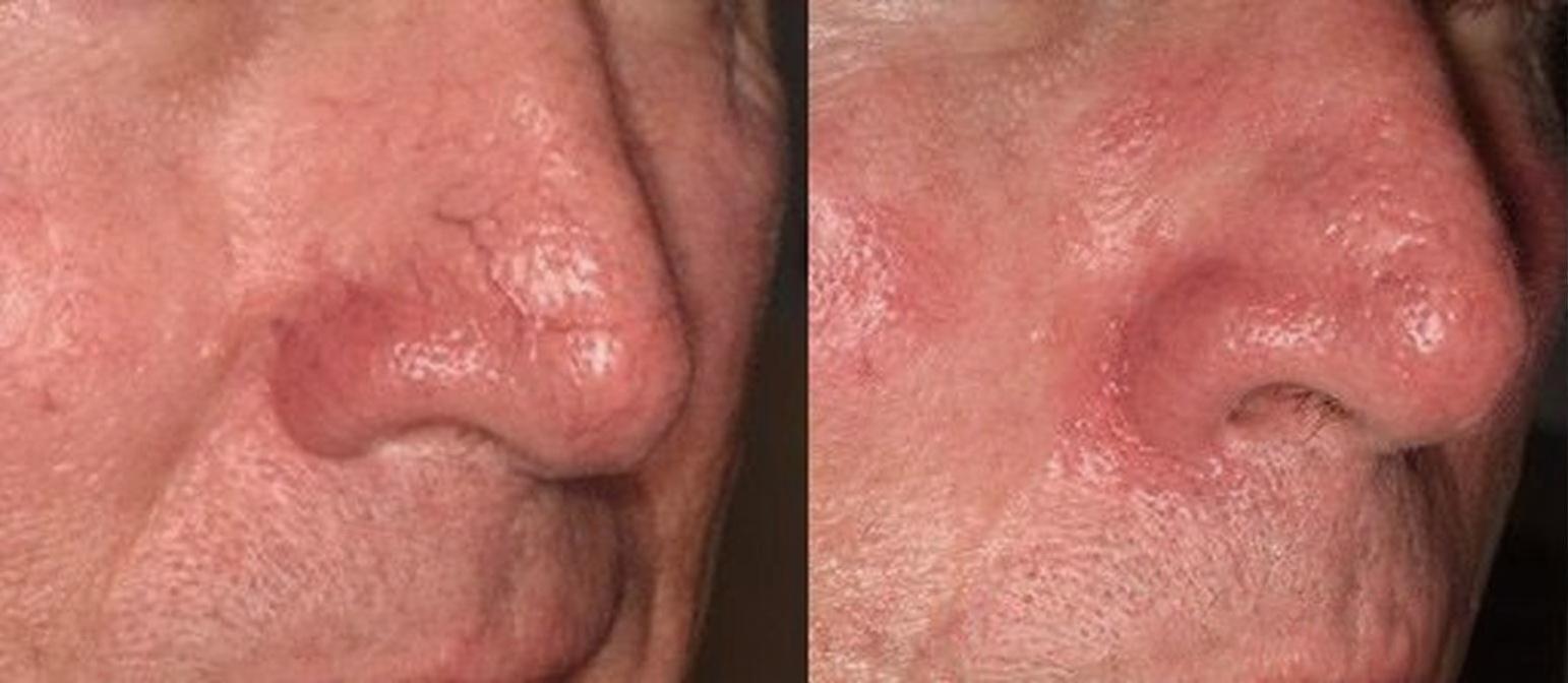 Lumecca IPL Before and After - Nose Rosacea Treatment