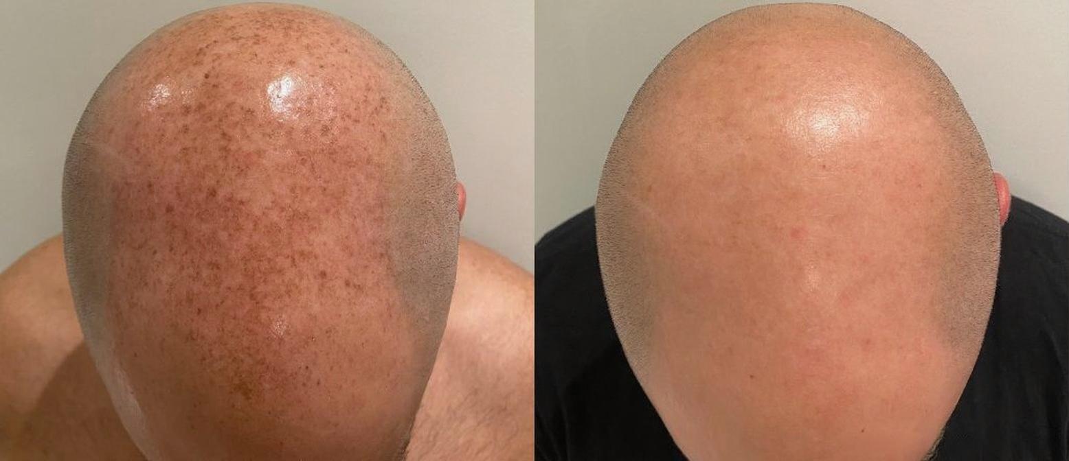 Lumecca IPL Before and After - Scalp Pigmentation