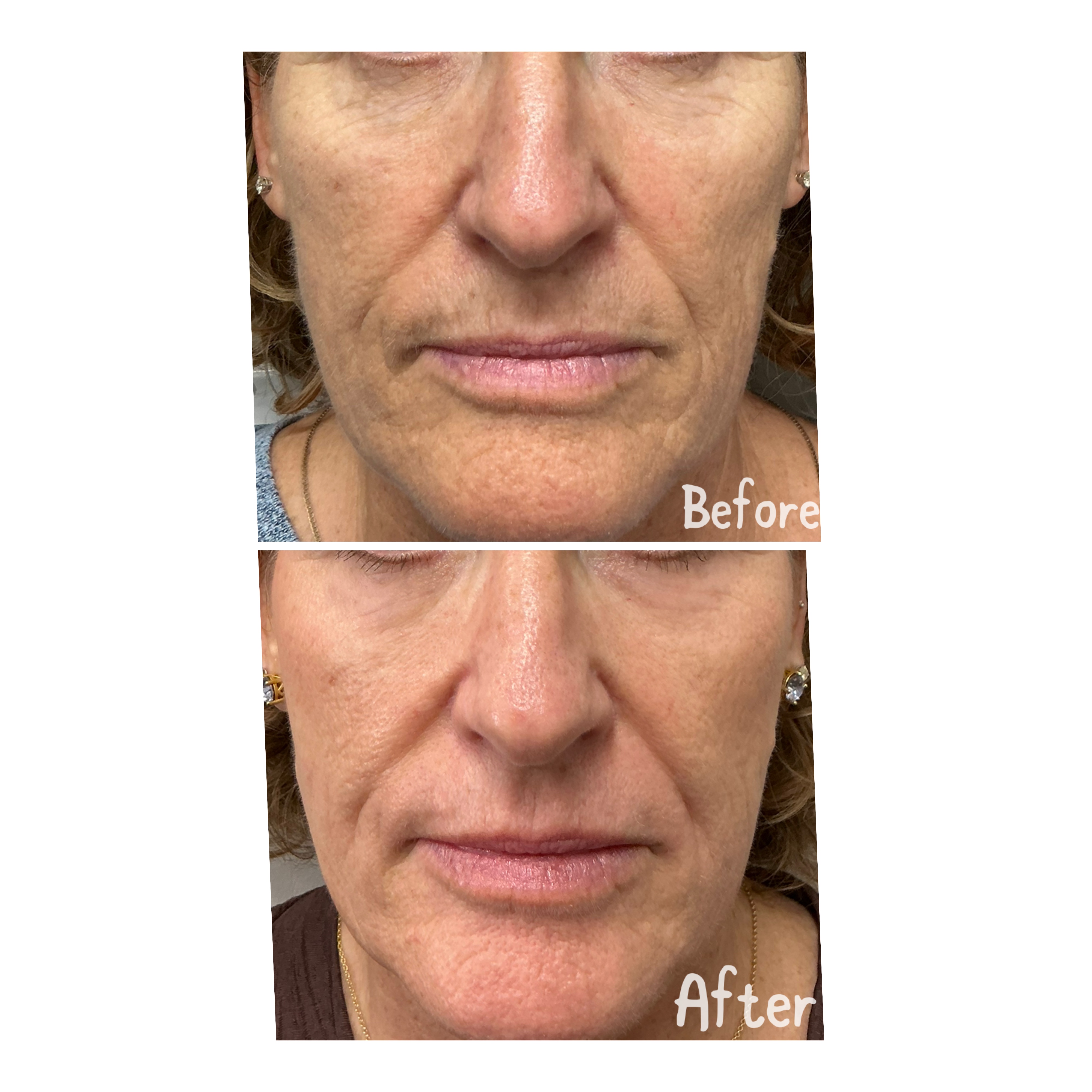Plexr Plus Treatment Results