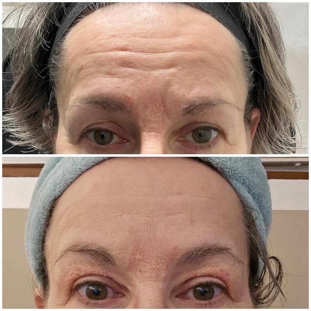 Plexr Plus Skin Rejuvenation