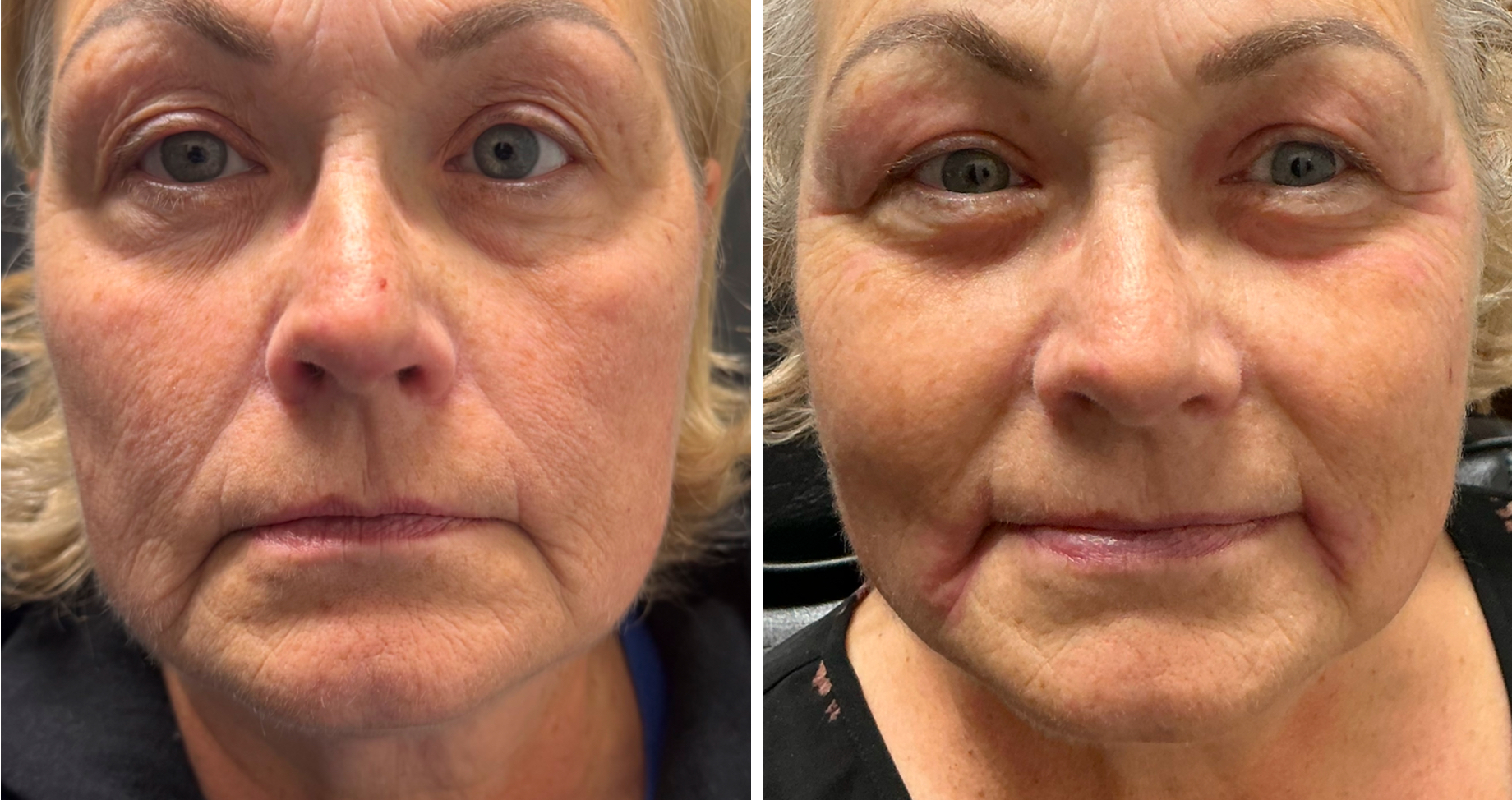 Plexr Plus Treatment Excellence