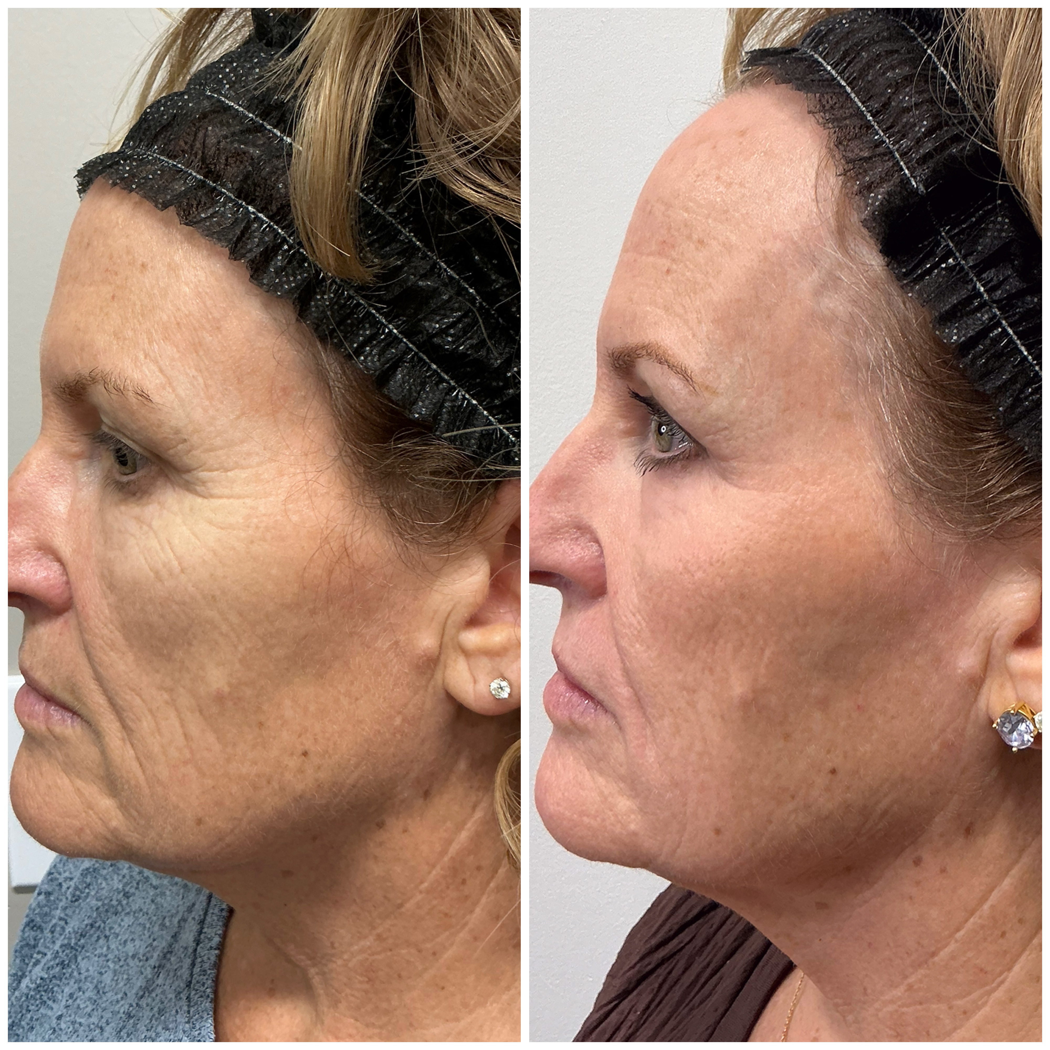 Plexr Plus Clinical Results