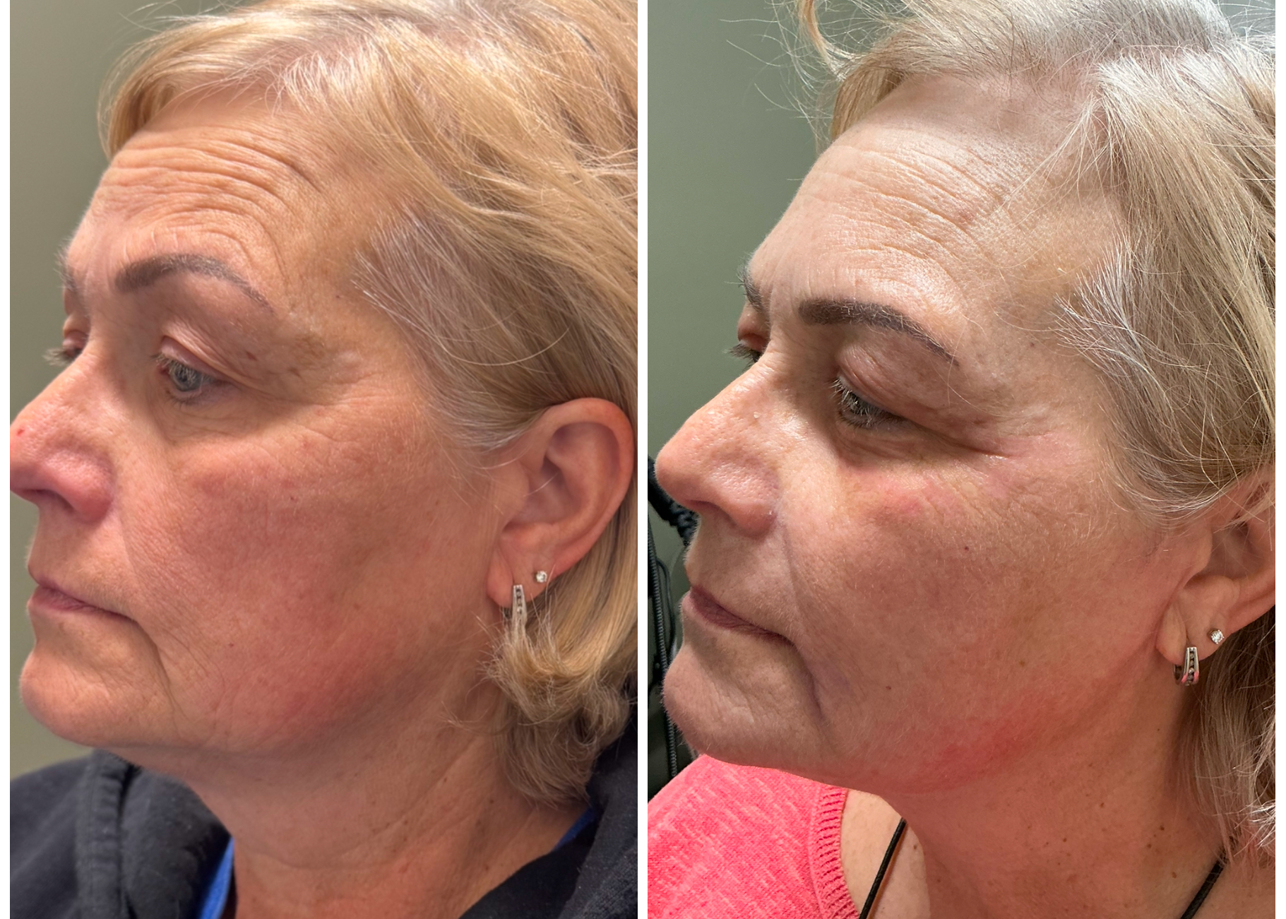 Plexr Plus Advanced Treatment