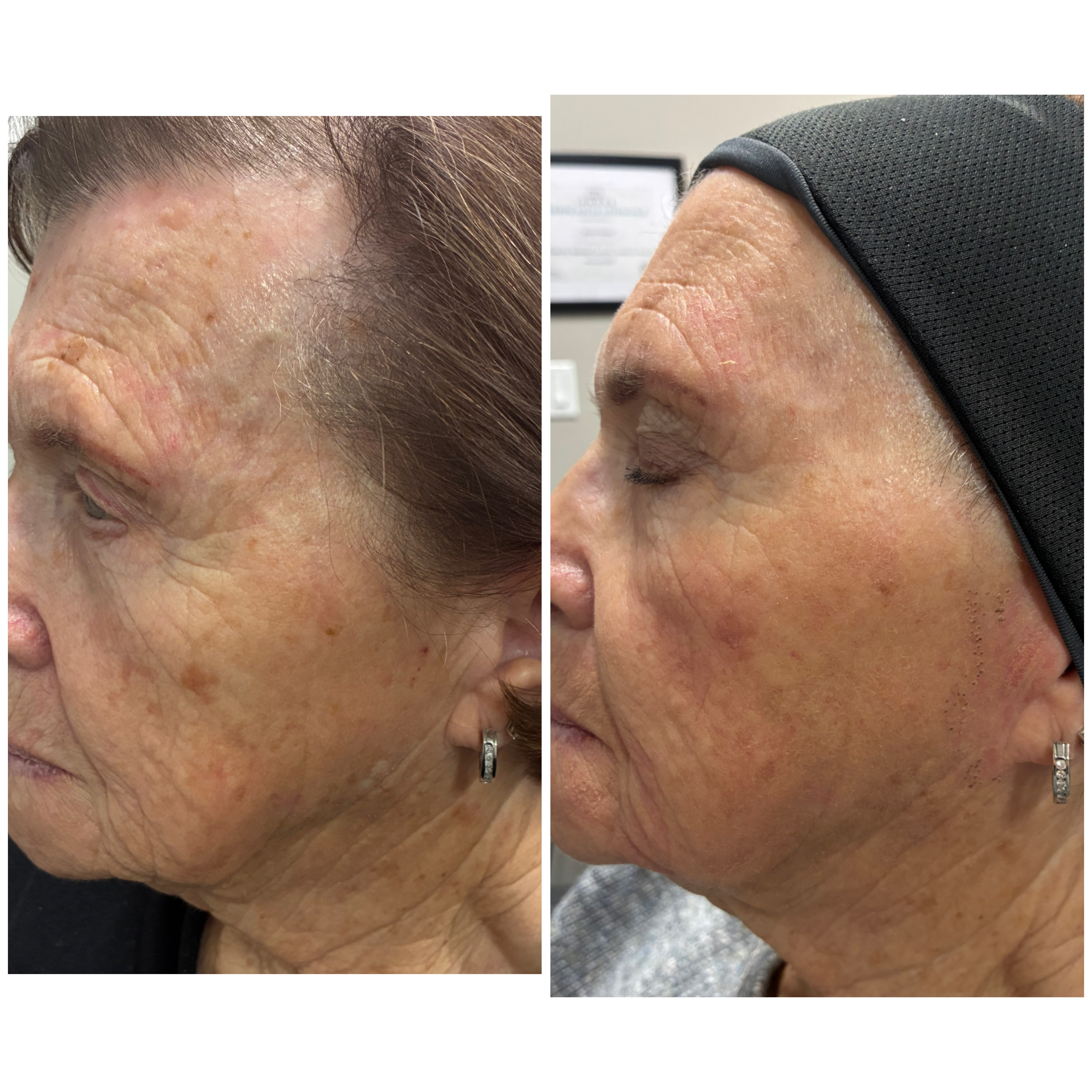 Plexr Plus Professional Results