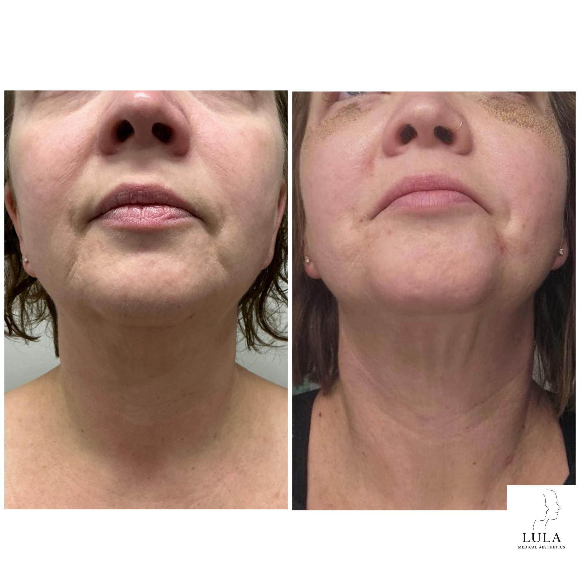 Plexr Plus Effective Treatment