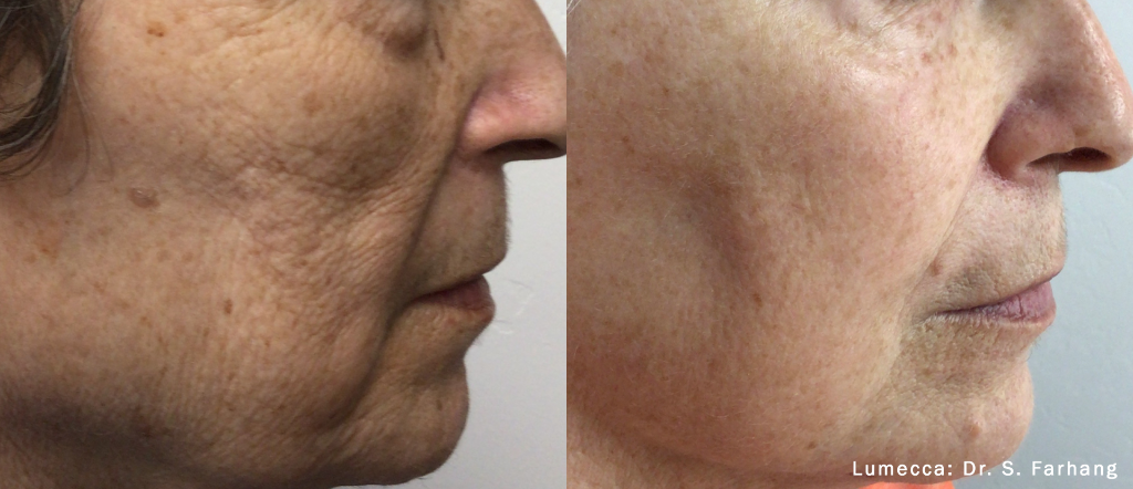 Plexr Plus Skin Transformation