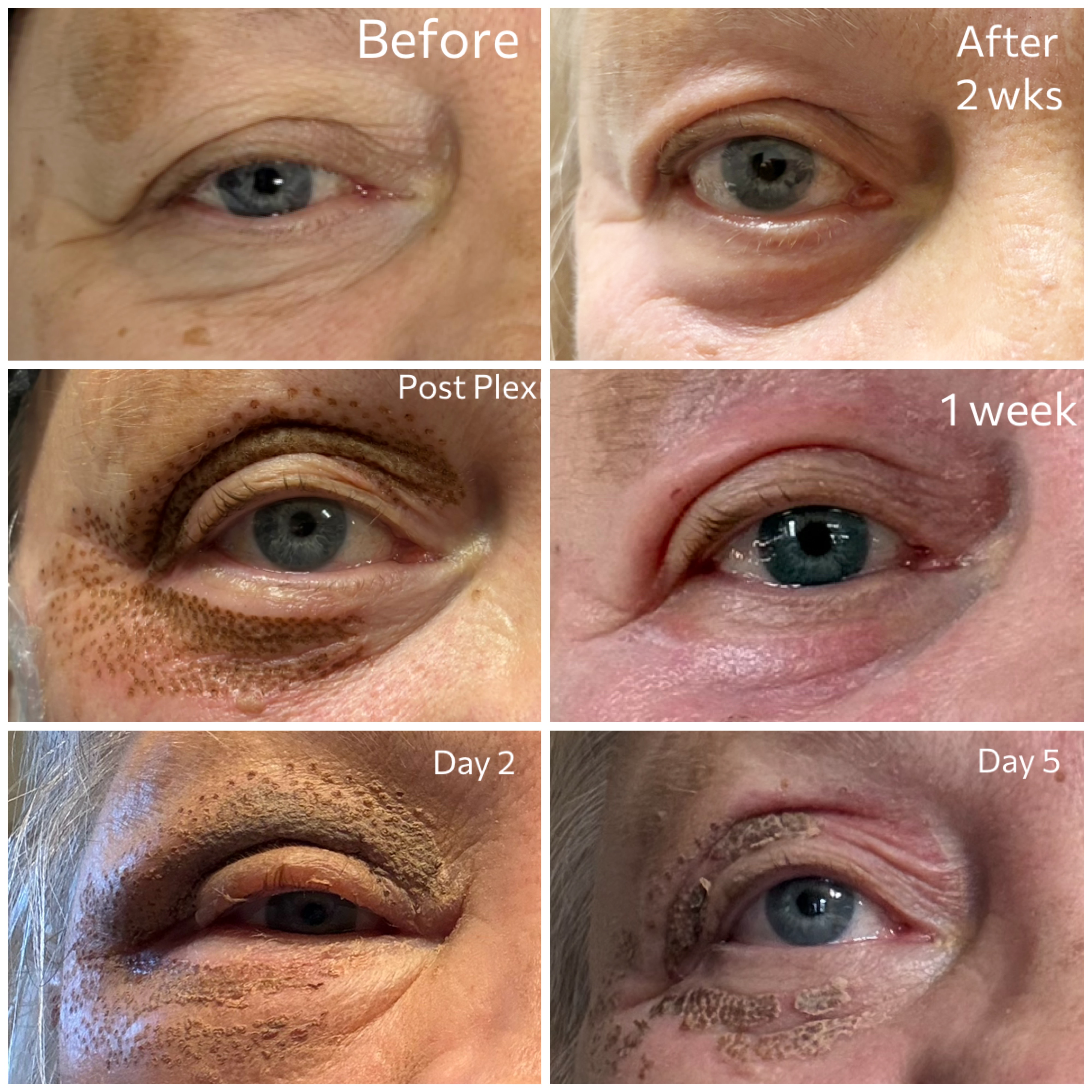 Plexr Plus Eyelid Before After Detail