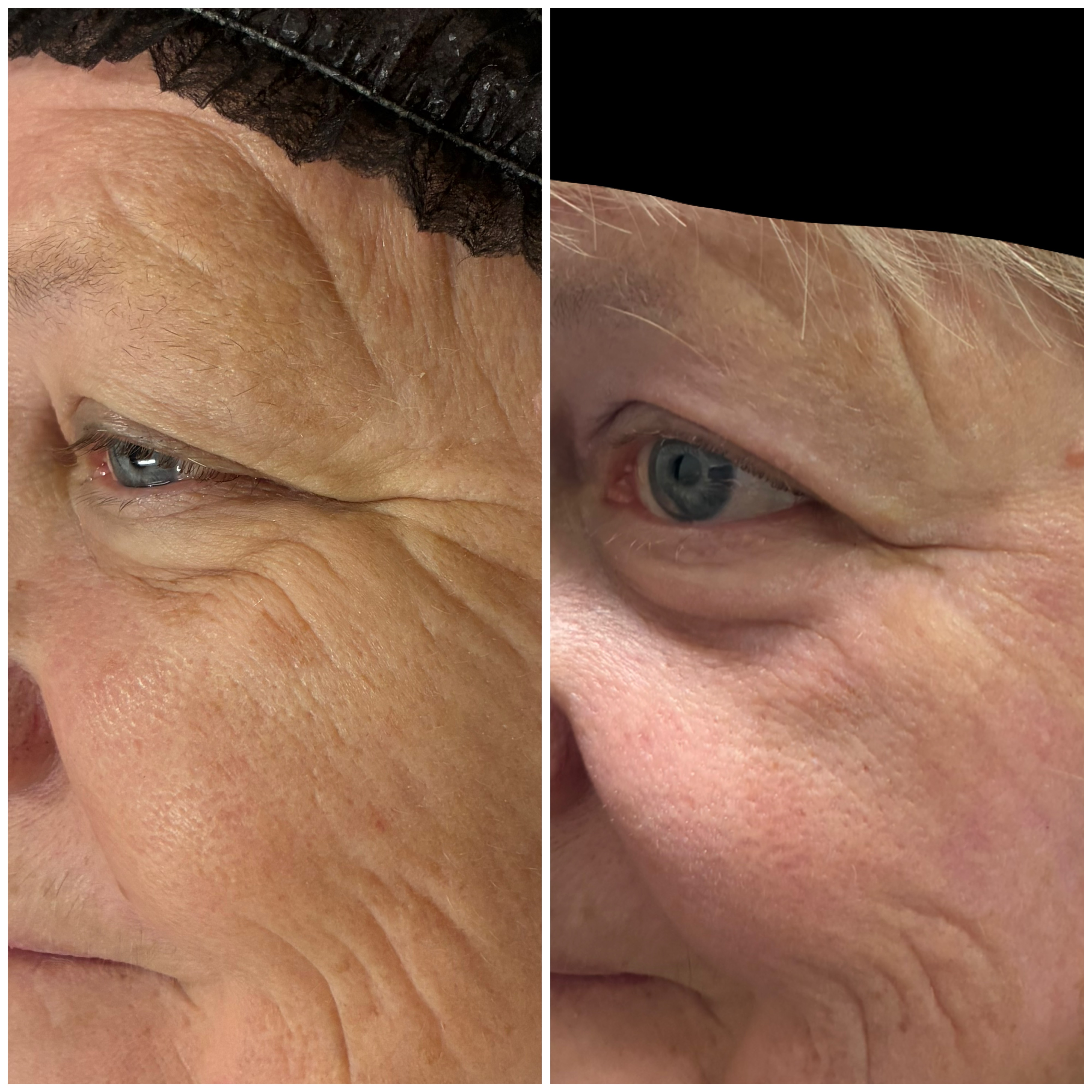 Plexr Plus Eye Area Results