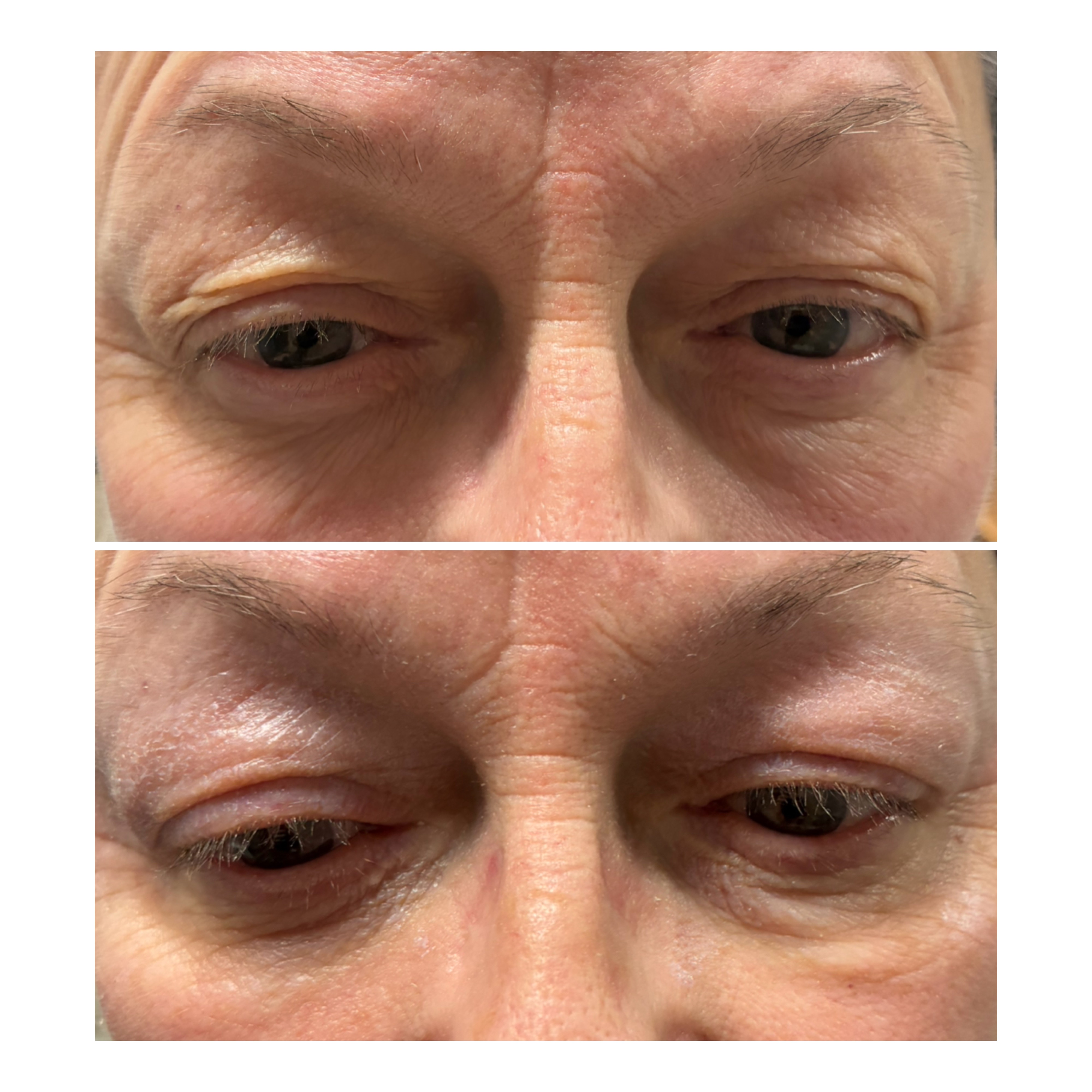 Plexr Plus Non-Surgical Blepharoplasty