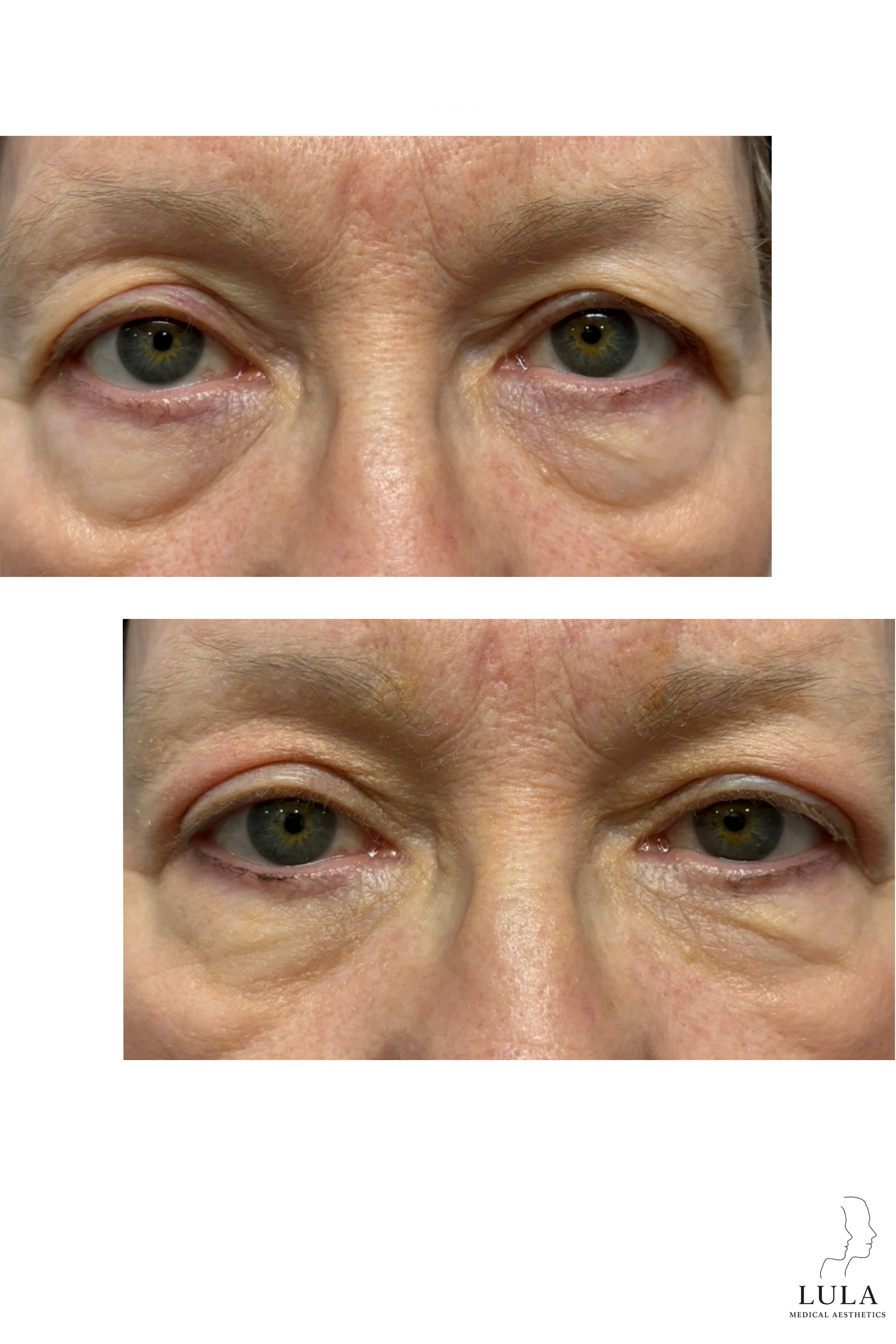 Plexr Plus Upper Lid Tightening