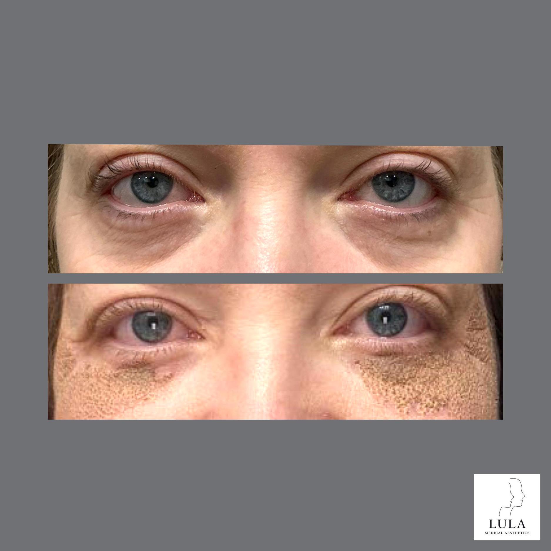Plexr Plus Eye Lift Results