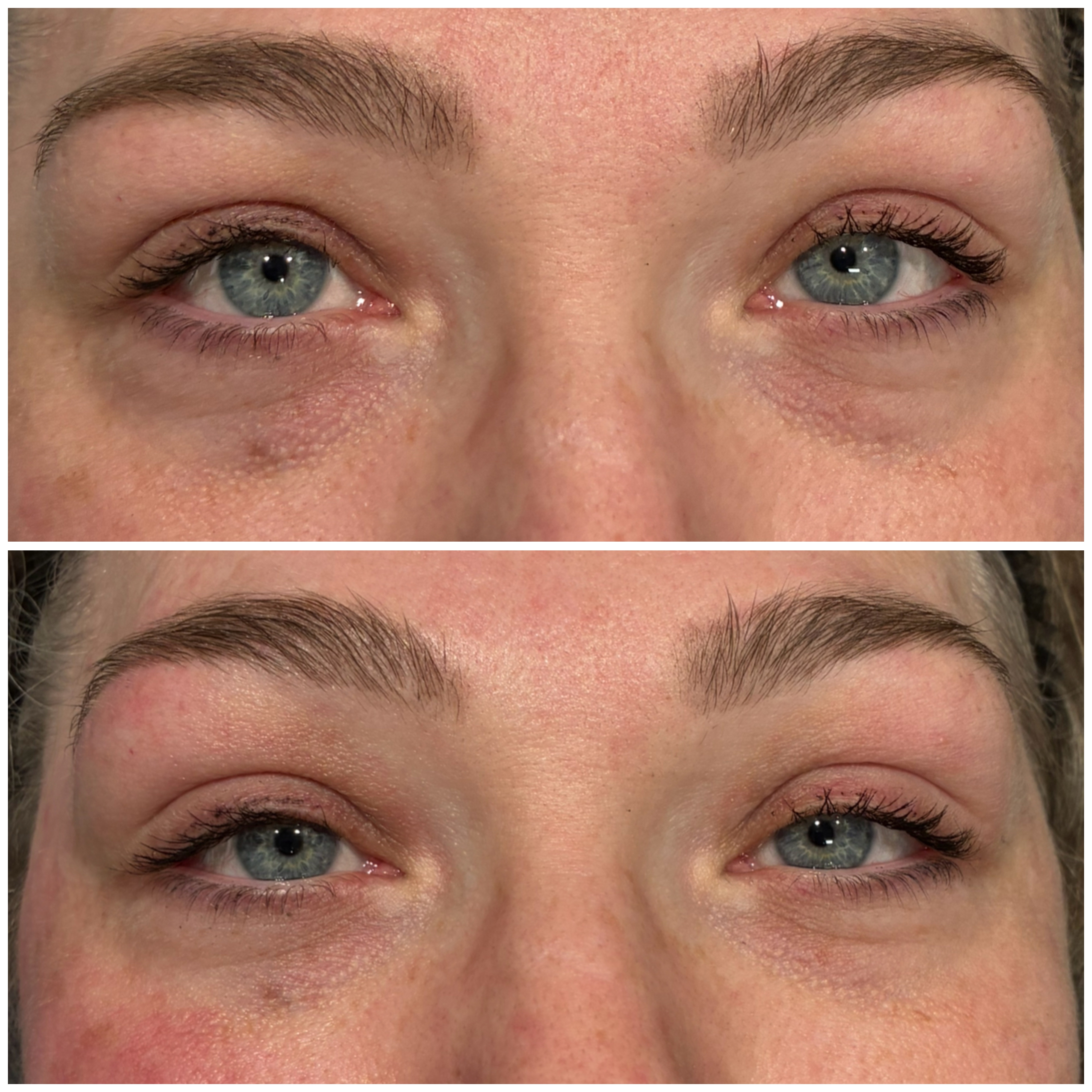 Plexr Plus Eyelid Lift Before After