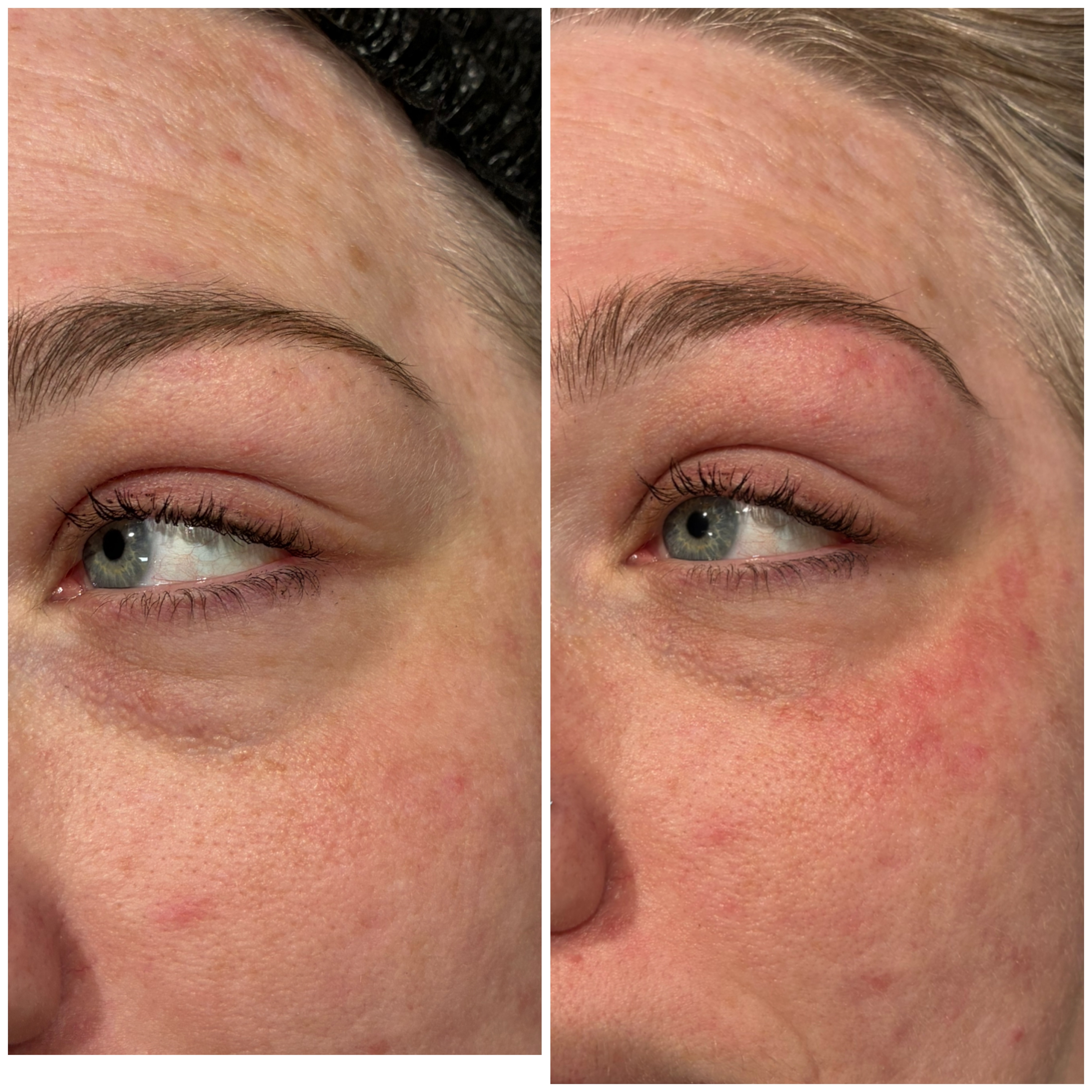 Plexr Plus Eyelid Tightening Results