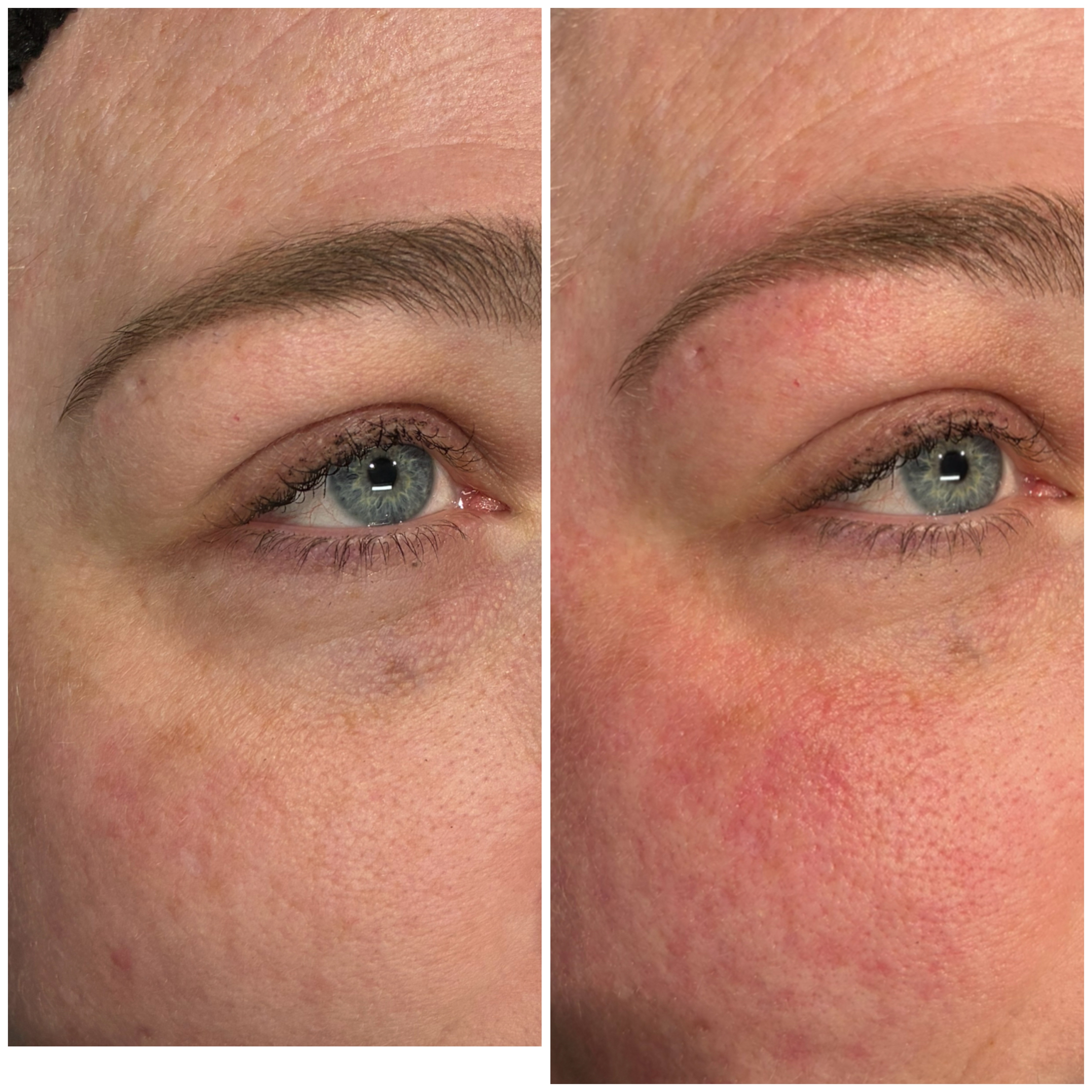 Plexr Plus Upper Eyelid Transformation