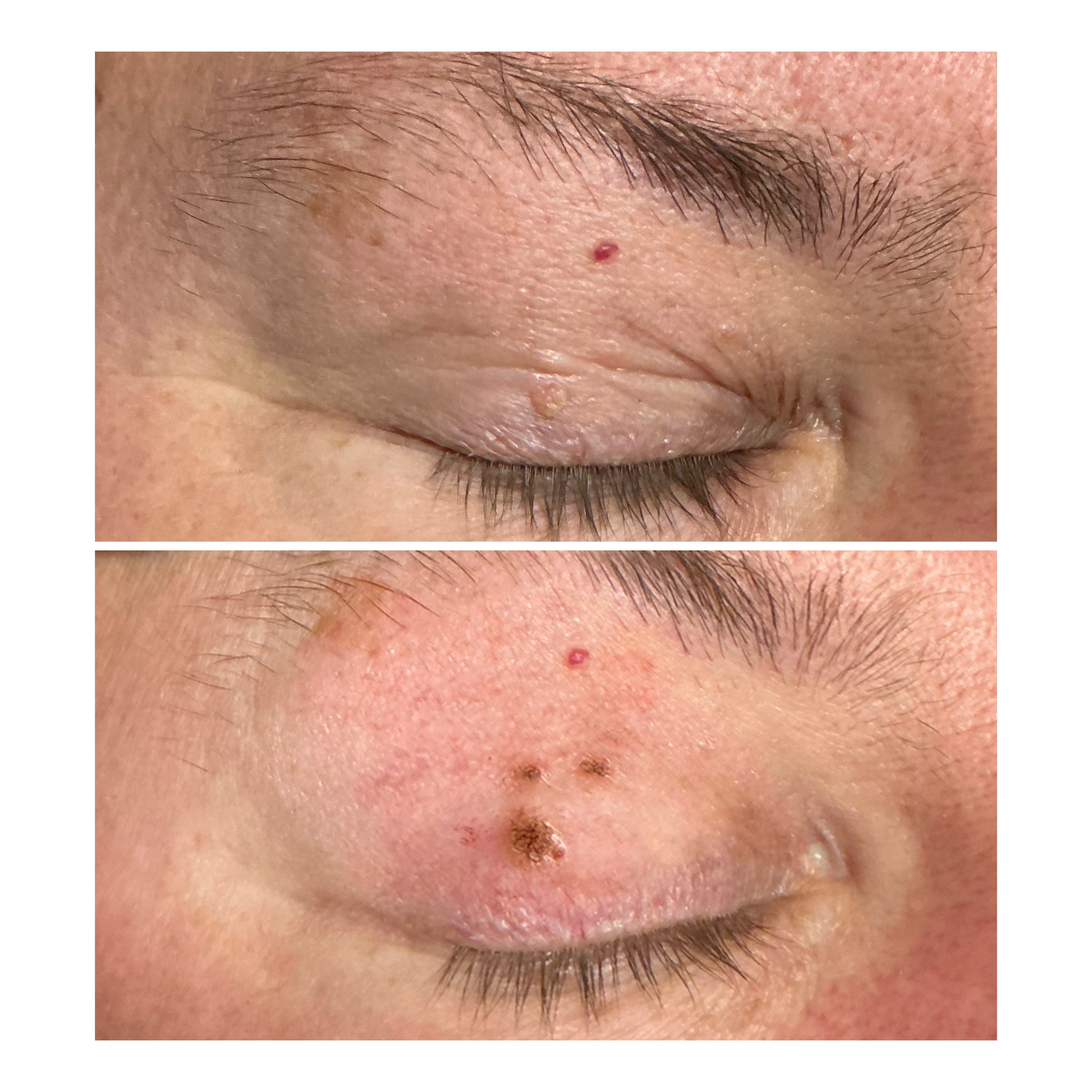 Plexr Plus Skin Tag Removal