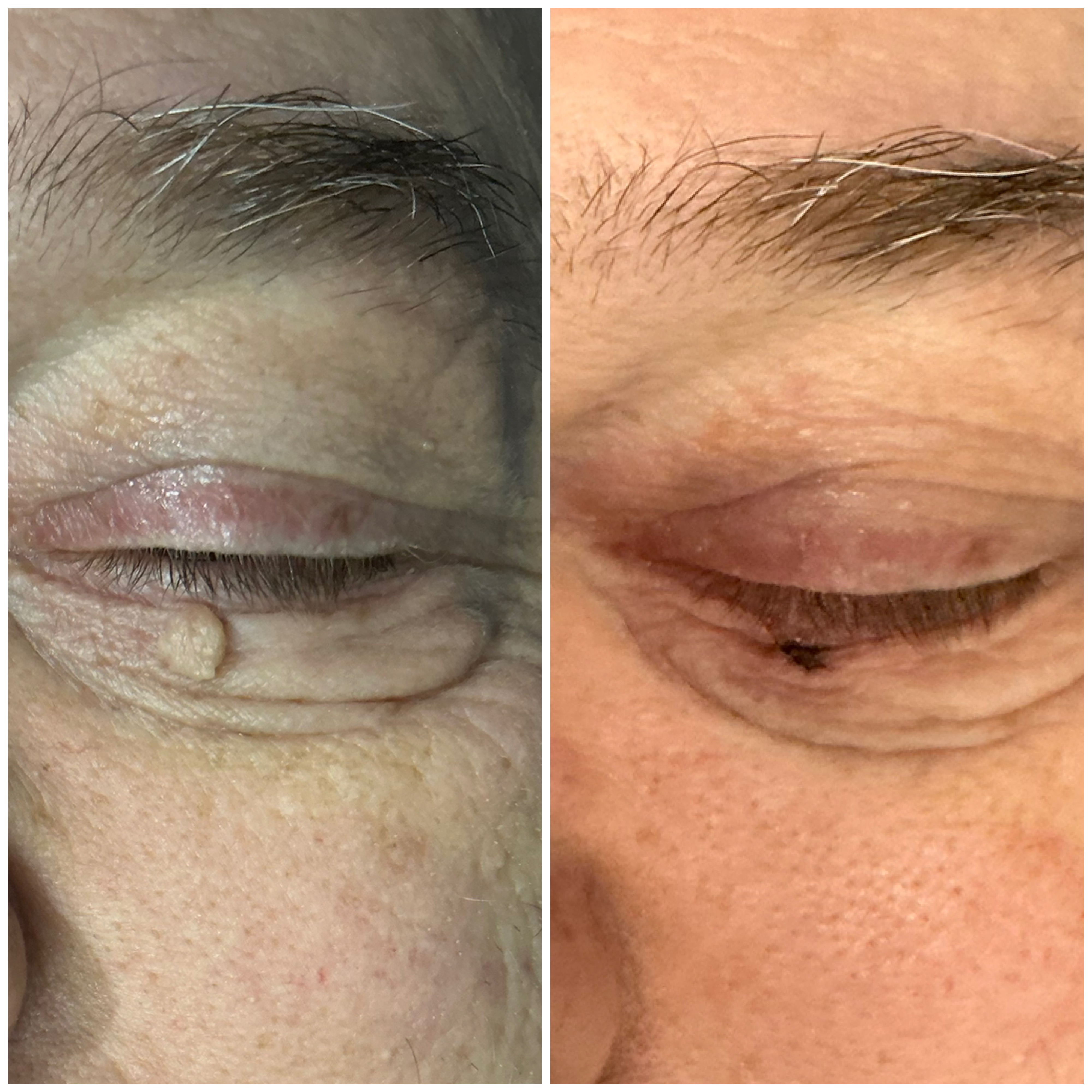 Plexr Plus Lesion Removal Results