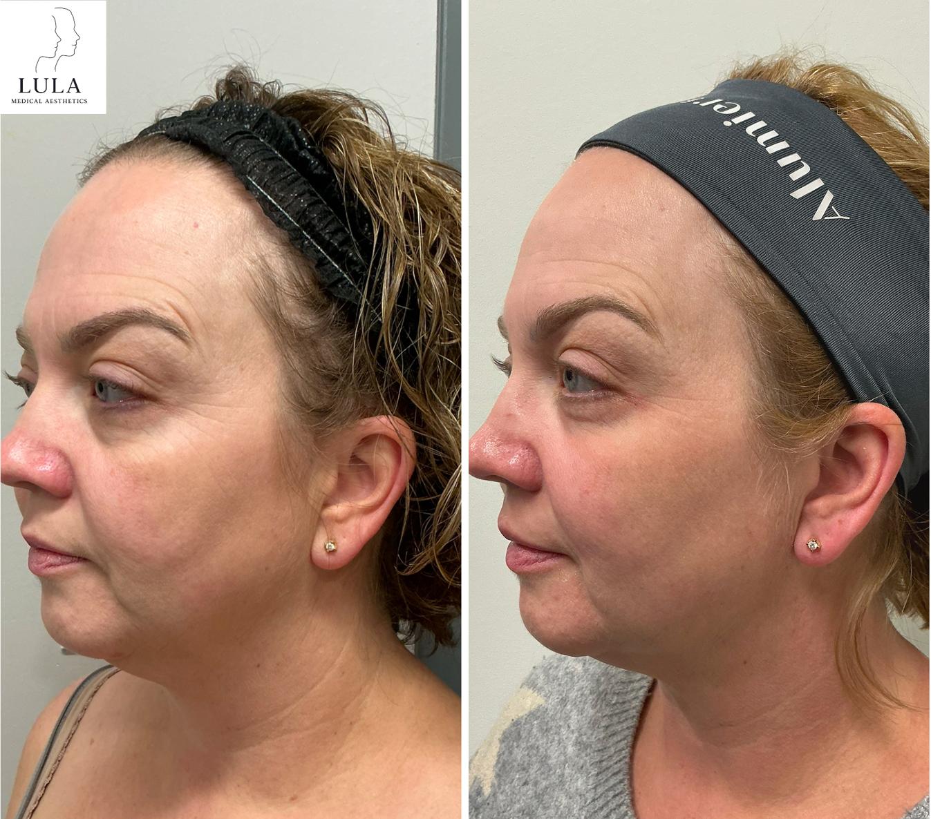 TriLift Treatment Results