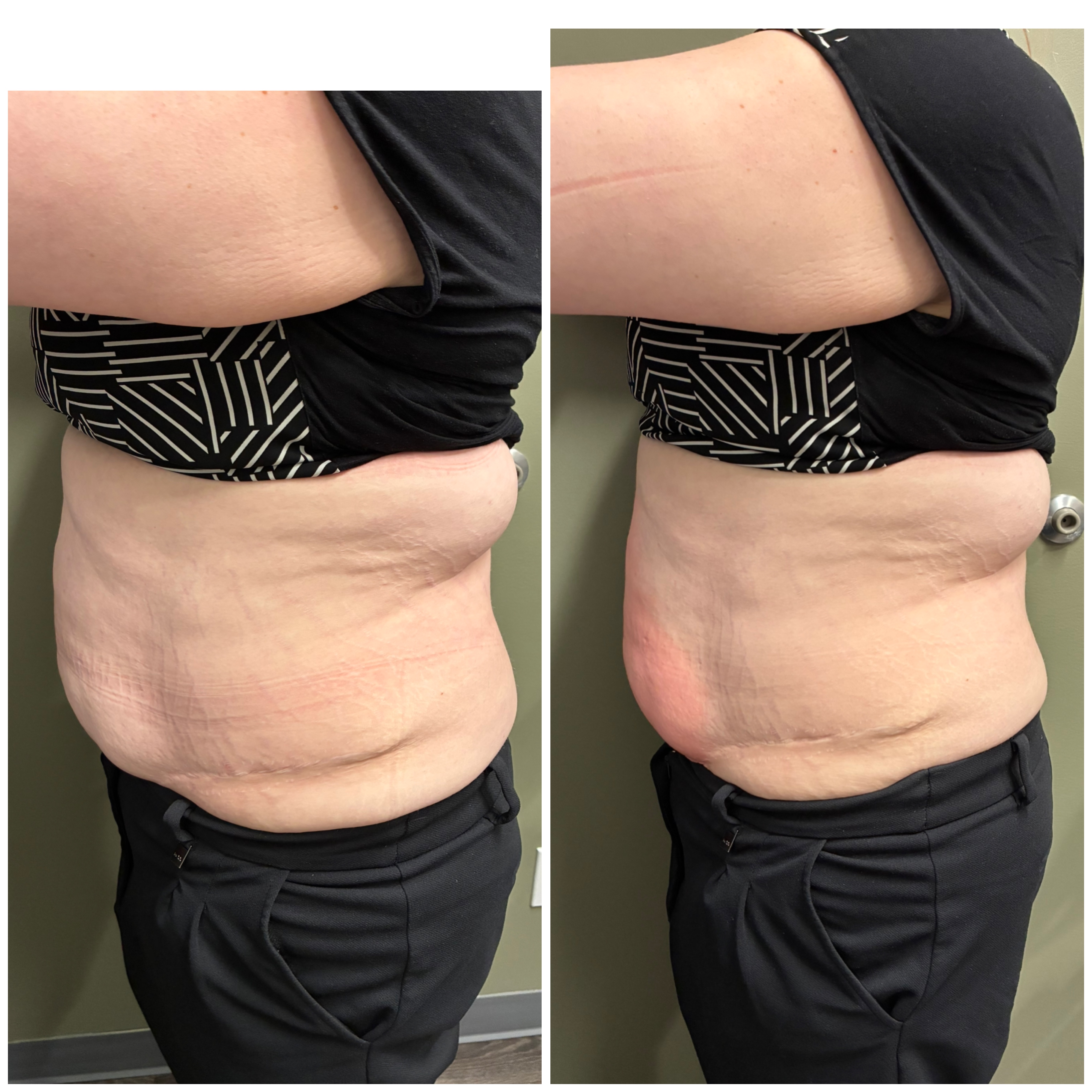 TriLift Before and After - Facial Lifting Results