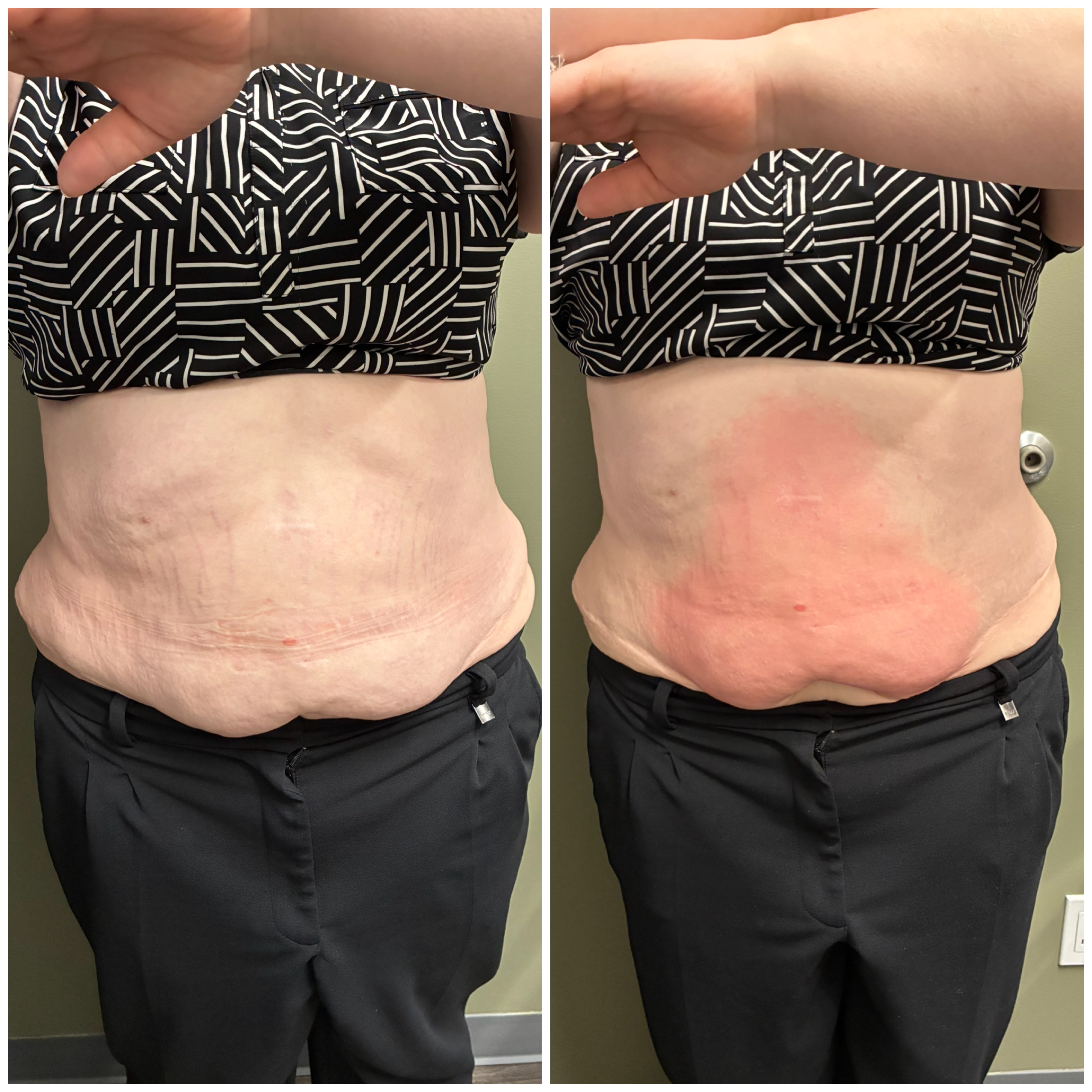 TriLift Before and After - Skin Tightening